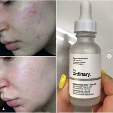 The Ordinary Niacinamide 10% + Zinc 1 % Serum